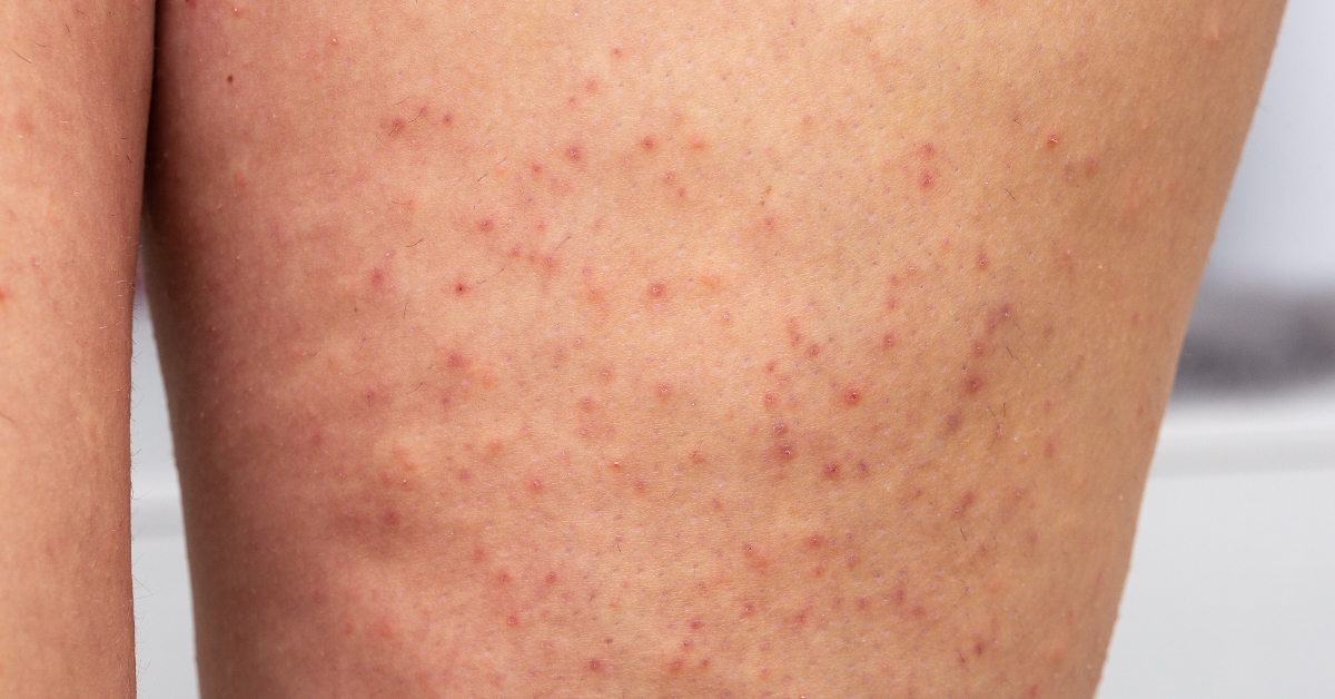 Keratosis Pilaris