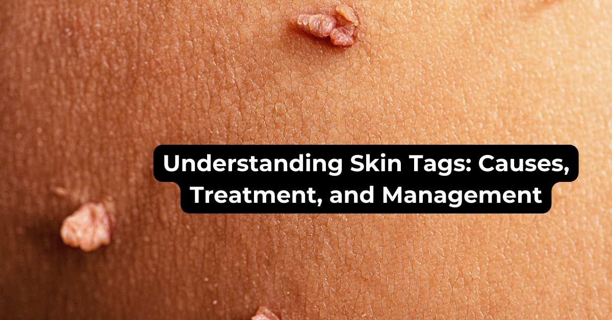 Skin Tags