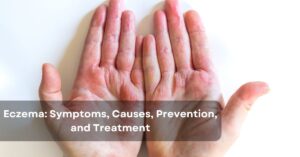 eczema