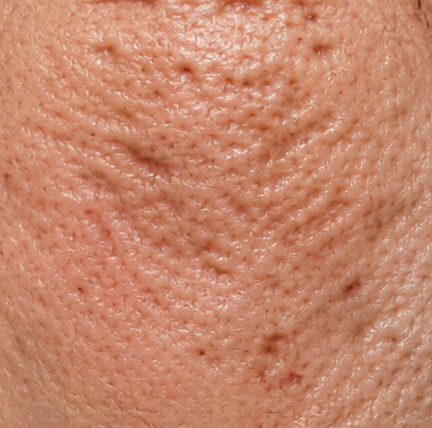 Acne scar revision treatment before result