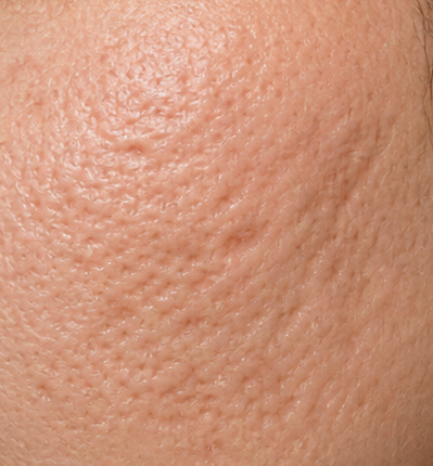 Acne scar revision treatment after result