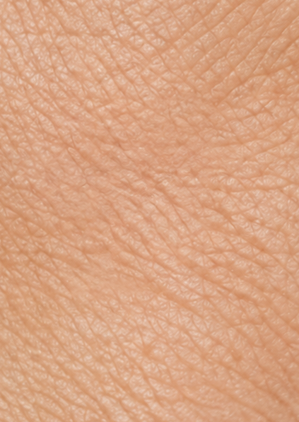 Commonly affected areas in keratosis pilaris