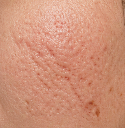 Acne scar revision treatment before result