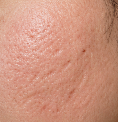 Acne scar revision treatment after result