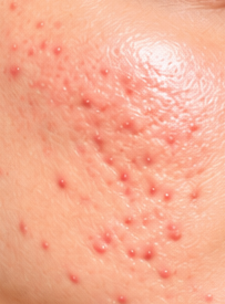 Acne scars and uneven skin texture