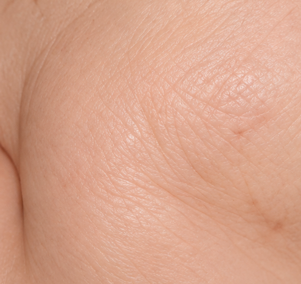 Dry rough skin texture
