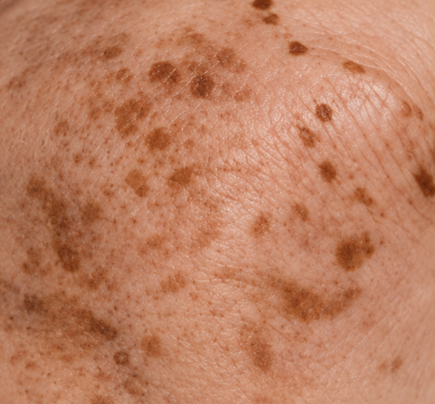 Small rough bumps caused by keratosis pilaris