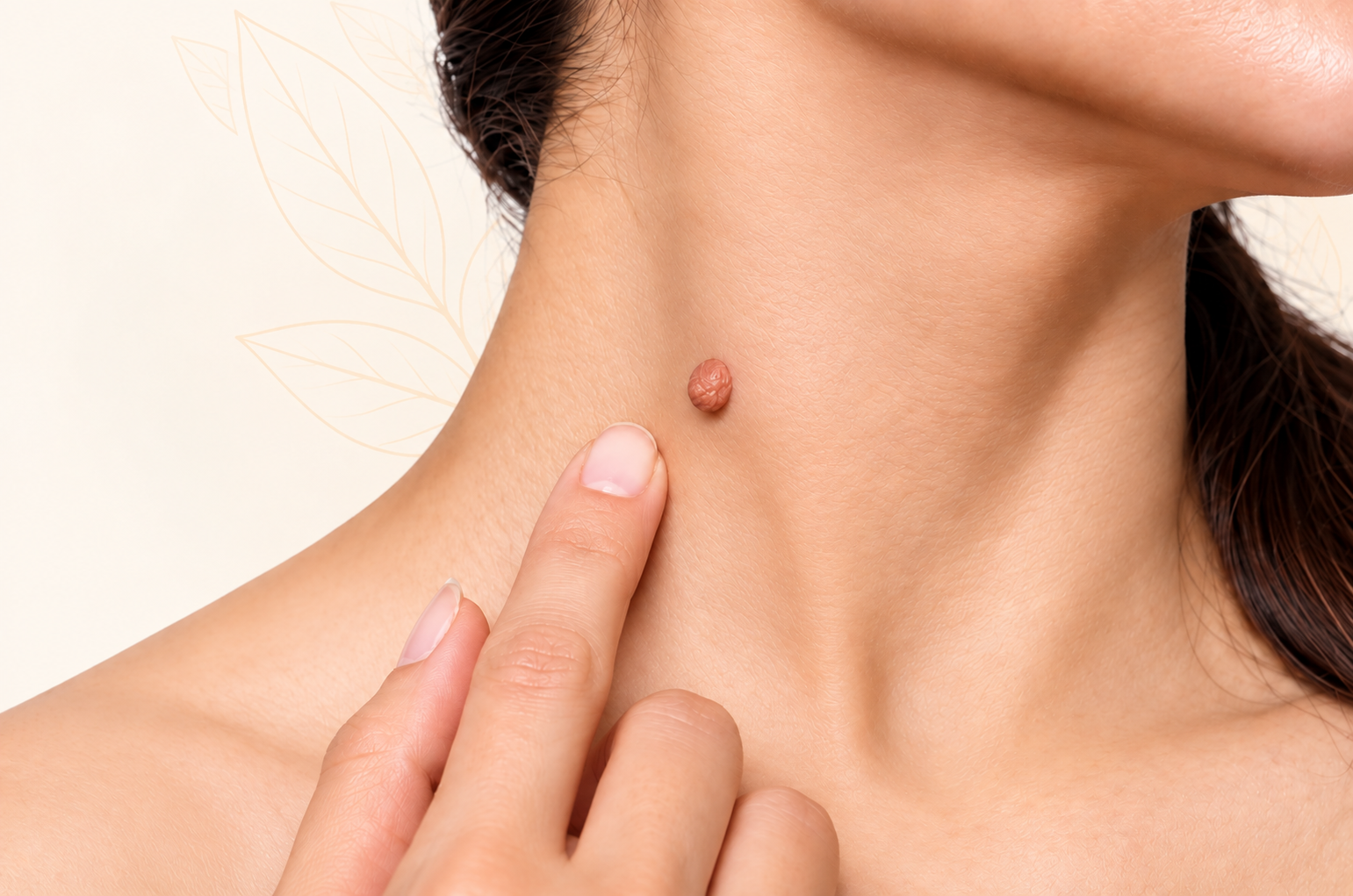 Skin tag on the neck