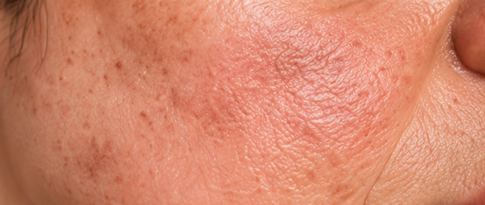 Premature skin ageing