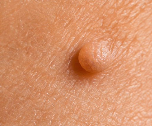 Small soft skin tag growth