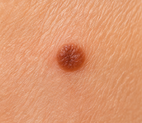 Skin colored or slightly darker skin tag