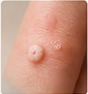 Wart on finger