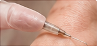 Bleomycin treatment for warts