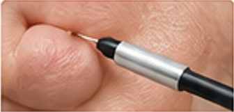 Electrosurgery treatment for warts