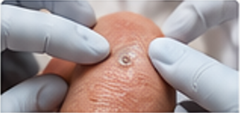 Personalized wart removal treatment